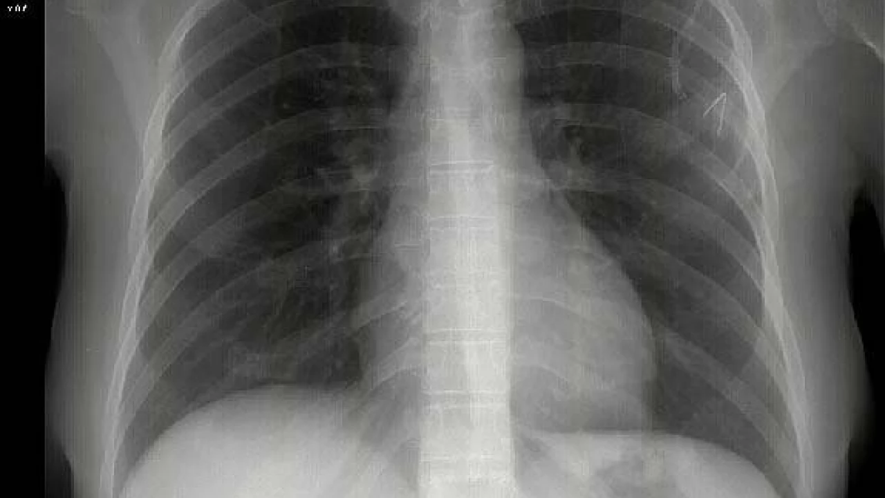 Ruszają bezpłatne badania RTG