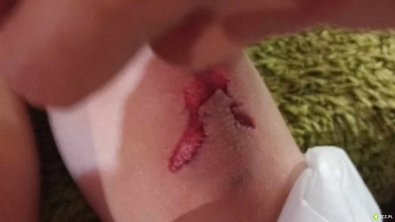 Dziesięć szwów i rana szarpana - wypadek w sali zabaw [AKTUALIZACJA]